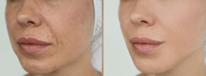Vrouw gezicht biopeeling
