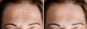 Voor en na microneedling