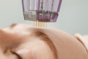 Microneedle voorhoofd vrouw